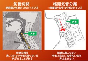 気管支胸膜瘻とは何ですか?